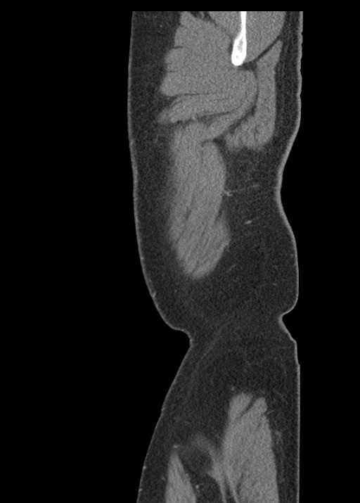 Acute appendicitis (Radiopaedia 48511-53463 Sagittal C+ portal venous phase 15).jpg