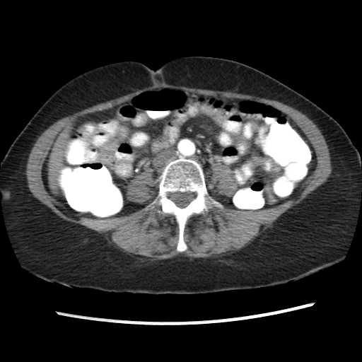 File:Acute appendicitis (Radiopaedia 52672-58589 Axial C+ arterial phase 5).jpg