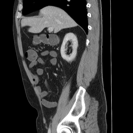 Acute appendicitis (Radiopaedia 66513-75790 Sagittal C+ portal venous phase 50).jpg