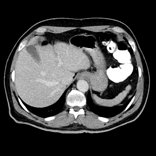 Acute appendicitis (Radiopaedia 77016-88960 Axial C+ portal venous phase 30).jpg