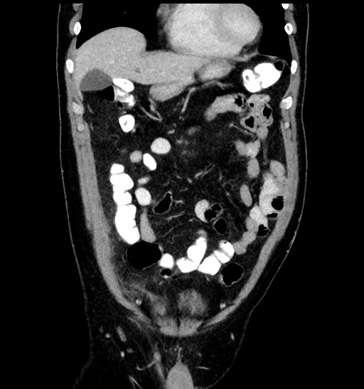Acute appendicitis (Radiopaedia 77016-88960 Coronal C+ portal venous phase 33).jpg