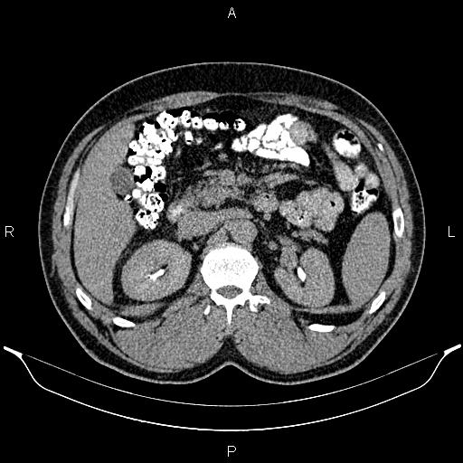 File:Acute appendicitis (Radiopaedia 84780-100240 Axial C+ delayed 37).jpg