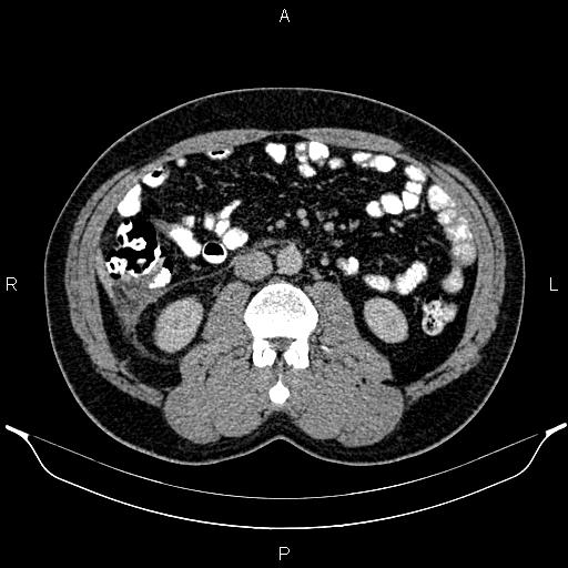 File:Acute appendicitis (Radiopaedia 84780-100240 Axial C+ portal venous phase 52).jpg