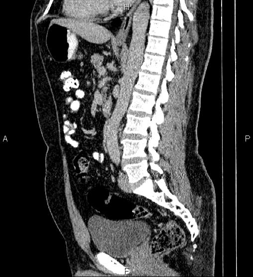 File:Acute appendicitis (Radiopaedia 84780-100240 Sagittal C+ portal venous phase 56).jpg
