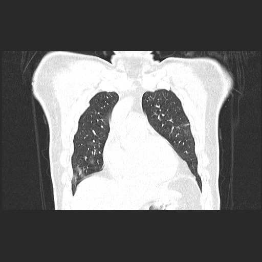 Acute appendicitis and COVID 19 pneumonia (Radiopaedia 76604-88380 G 19).jpg