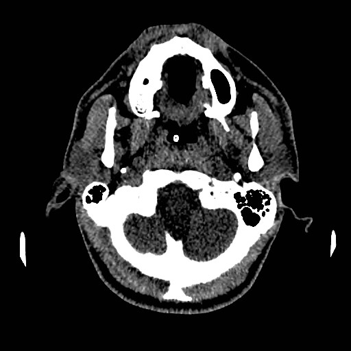 Acute basilar artery occlusion (Radiopaedia 43582-46985 Axial non-contrast 31).jpg
