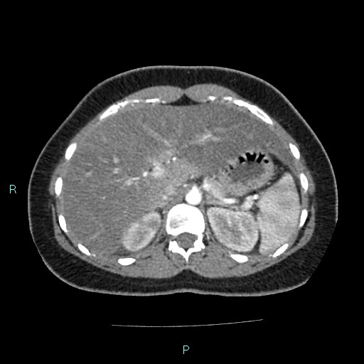 File:Acute bilateral pyelonephritis (Radiopaedia 37146-38881 Axial C+ arterial phase 46).jpg
