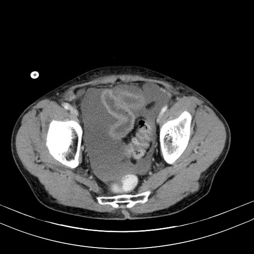 Acute bowel ischemia (Radiopaedia 87695-104114 Axial C+ portal venous phase 76).jpg