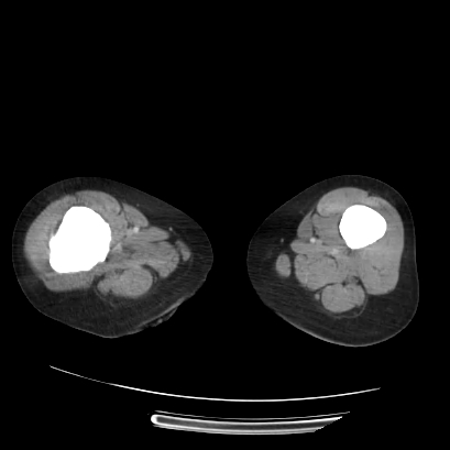 Acute calculous cholecystitis in patient with osteopetrosis (Radiopaedia 77871-90159 Axial C+ portal venous phase 93).jpg