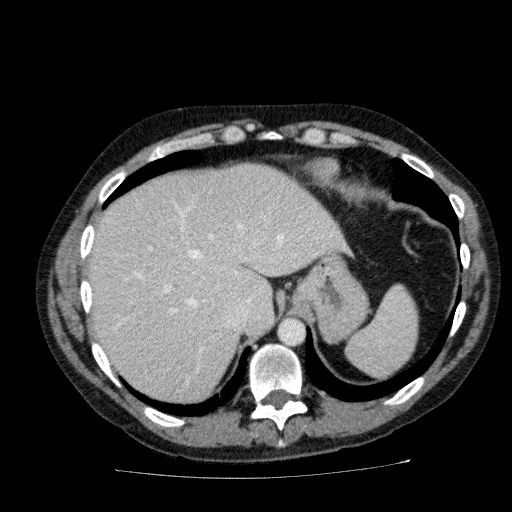 File:Acute cholecystitis and incidental left sided IVC (Radiopaedia 49352-54459 Axial C+ portal venous phase 34).jpg