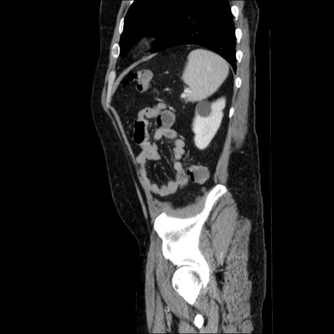 Acute cholecystitis and incidental left sided IVC (Radiopaedia 49352-54459 Sagittal C+ portal venous phase 24).jpg