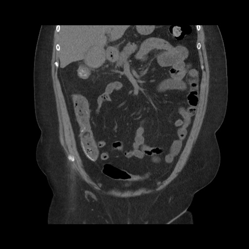 Acute cholecystitis with tensile fundus sign (Radiopaedia 71394-81723 Coronal non-contrast 53).jpg