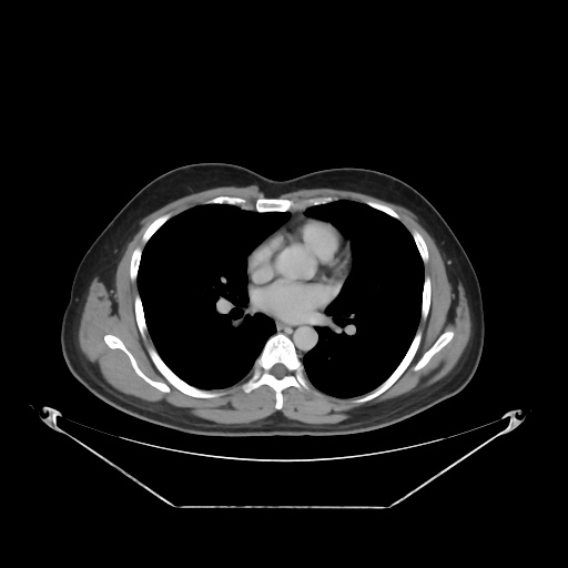 File:Acute complicated calculous cholecystitis (Radiopaedia 55202-61587 Axial C+ delayed 6).jpg