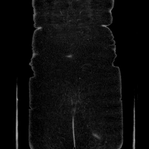 Acute diverticulitis - transverse colon (Radiopaedia 87063-103327 Coronal C+ portal venous phase 155).jpg