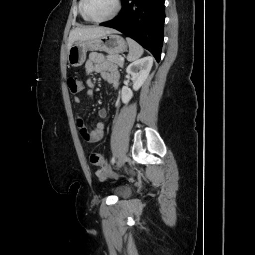 Acute diverticulitis - transverse colon (Radiopaedia 87063-103327 Sagittal C+ portal venous phase 147).jpg