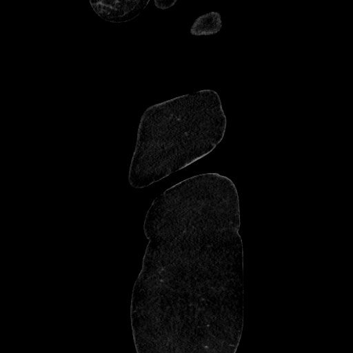 Acute diverticulitis - transverse colon (Radiopaedia 87063-103327 Sagittal C+ portal venous phase 20).jpg