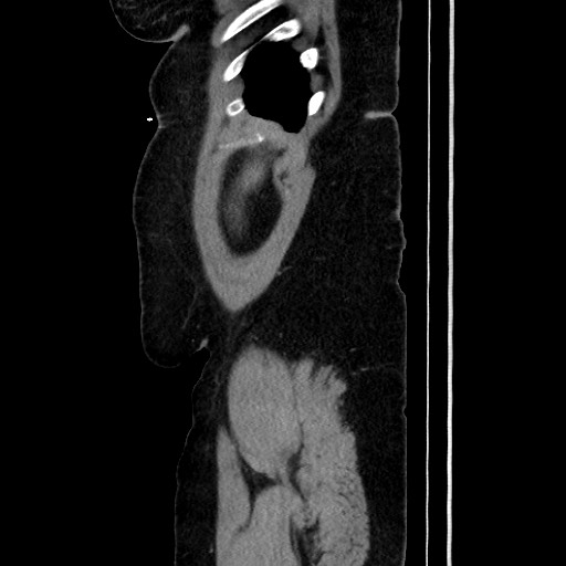 Acute diverticulitis - transverse colon (Radiopaedia 87063-103327 Sagittal C+ portal venous phase 49).jpg