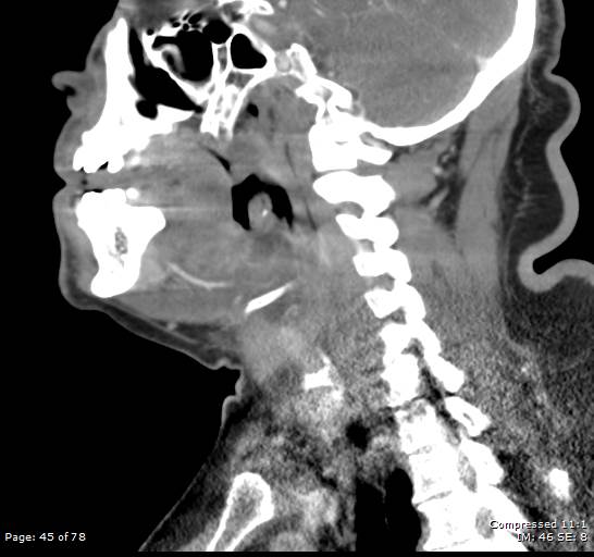 Acute epiglottitis (Radiopaedia 54375-60590 Sagittal C+ arterial phase 45).jpg