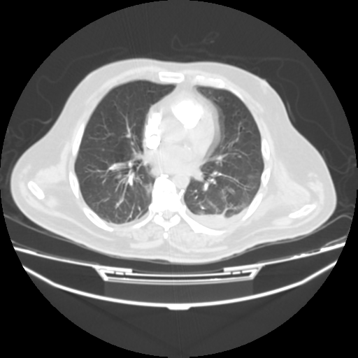 File:Acute heart failure (CT) (Radiopaedia 79835-93075 Axial lung window 25).png