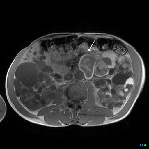File:Acute hemorrhage in a renal cyst in polycystic disease (MRI) (Radiopaedia 41702-44642 Axial T1 1).jpg