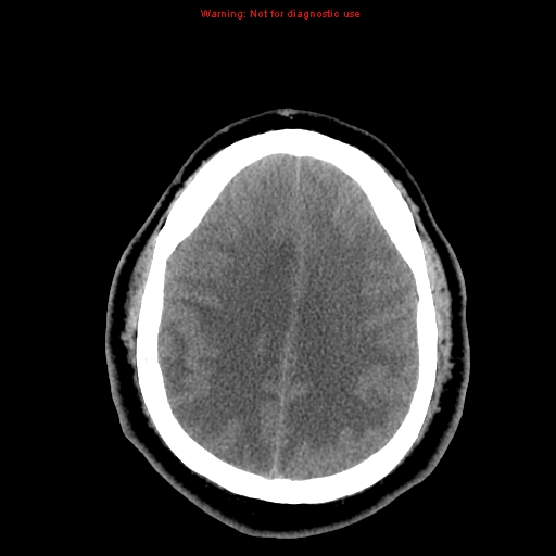 Acute hemorrhagic leukoencephalitis (Radiopaedia 14076-13920 Axial non-contrast 36).jpg