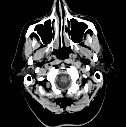 File:Acute internal carotid artery dissection (Radiopaedia 53541-59558 Axial non-contrast 4).jpg