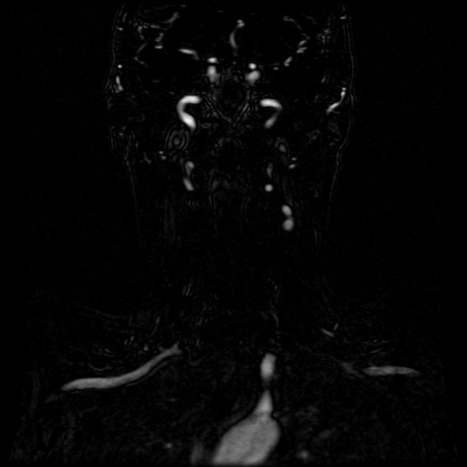 Acute internal carotid artery dissection (Radiopaedia 53541-59632 Coronal MRA 40).jpg