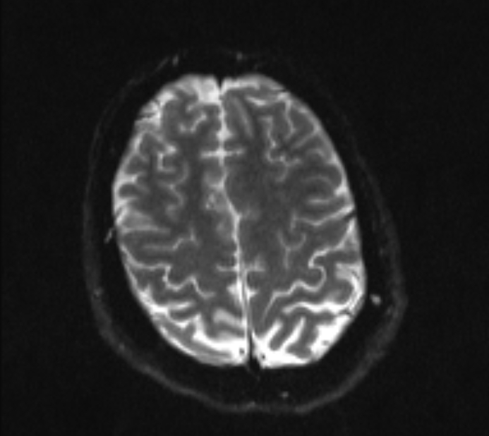 Acute ischemic stroke - posterior circulation territory (Radiopaedia 77670-89880 Axial DWI 19).jpg