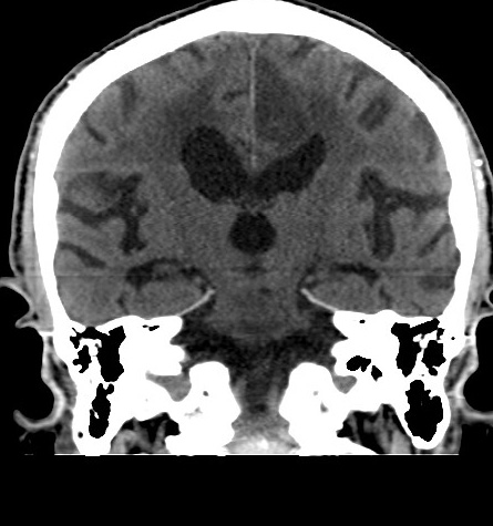 File:Acute left anterior cerebral artery territory infarction (Radiopaedia 51785-57578 Coronal non-contrast 33).jpg