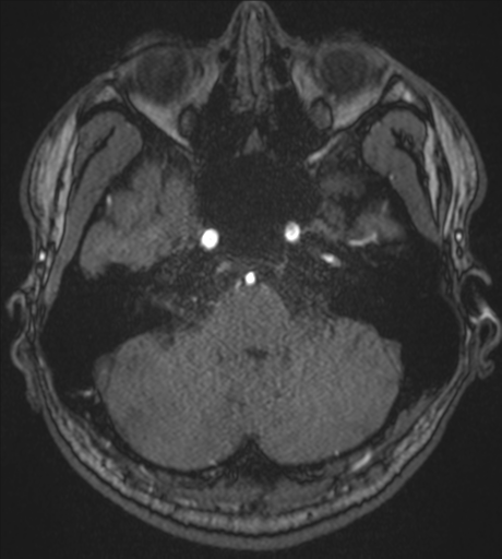 Acute left middle cerebral artery territory infarct with clot retrieval (Radiopaedia 47732-52433 Axial MRA 13).png