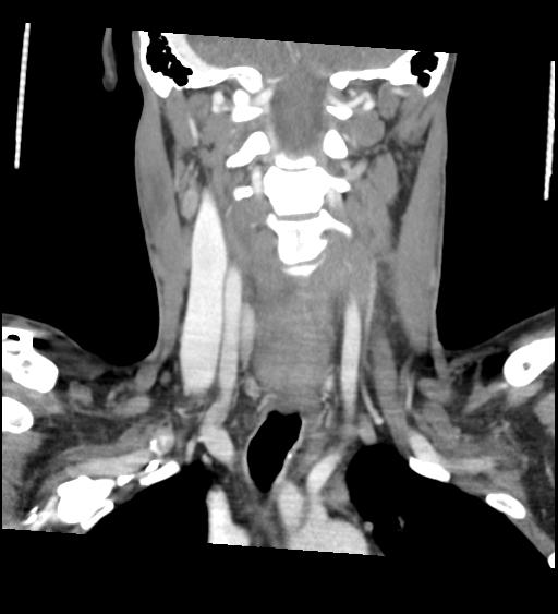 Acute longus colli calcific tendinitis (Radiopaedia 72495-83036 Coronal C+ arterial phase 38).jpg