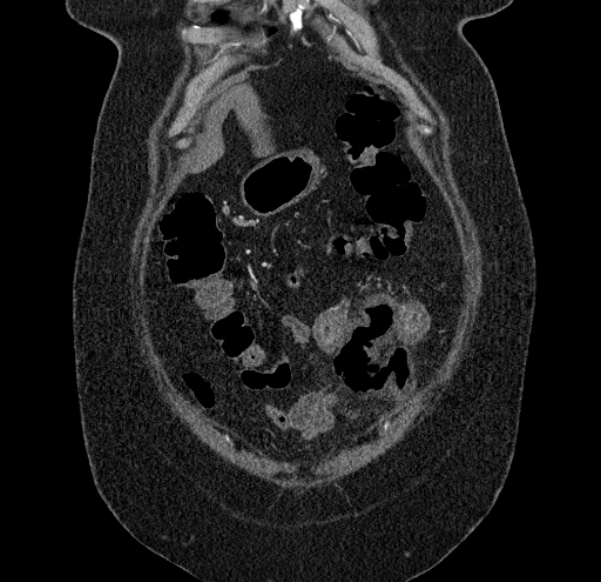 Acute mesenteric ischemia (Radiopaedia 80029-93316 Coronal C+ arterial phase 18).jpg