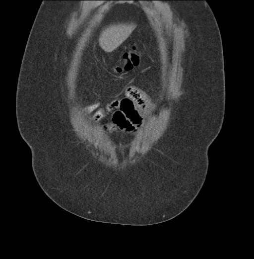 Acute mesenteric venous ischemia (Radiopaedia 46041-50383 Coronal C+ portal venous phase 13).jpg