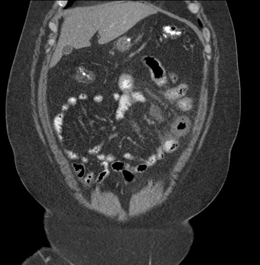 File:Acute mesenteric venous ischemia (Radiopaedia 46041-50383 Coronal C+ portal venous phase 24).jpg