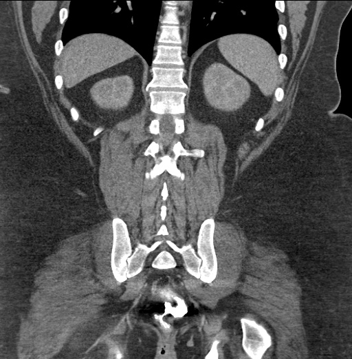 Acute mesenteric venous ischemia (Radiopaedia 46041-50383 Coronal C+ portal venous phase 74).jpg