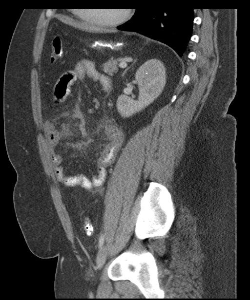 Acute mesenteric venous ischemia (Radiopaedia 46041-50383 Sagittal C+ portal venous phase 77).jpg