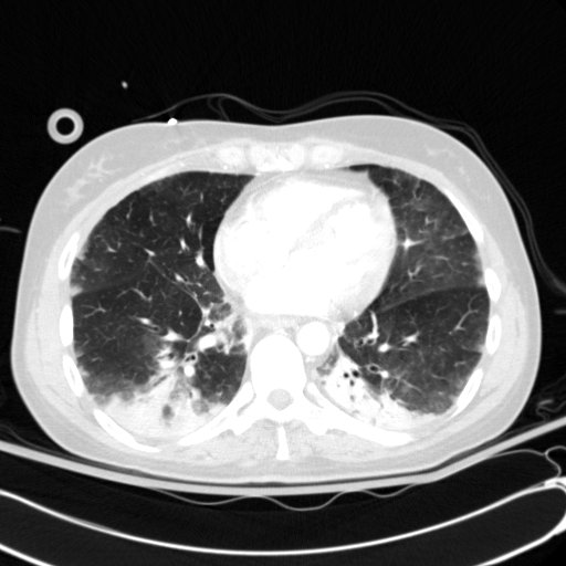 File:Acute myocardial infarction in CT (Radiopaedia 39947-42415 Axial lung window 85).jpg