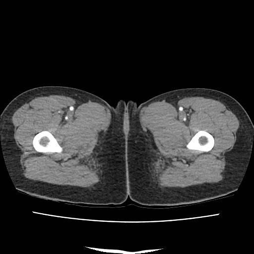 Acute myocarditis (Radiopaedia 55988-62613 Axial C+ portal venous phase 92).jpg