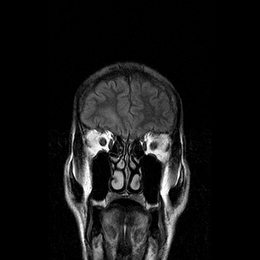 File:Acute necrotizing toxoplasma encephalitis (Radiopaedia 10683-11149 Coronal FLAIR 18).jpg