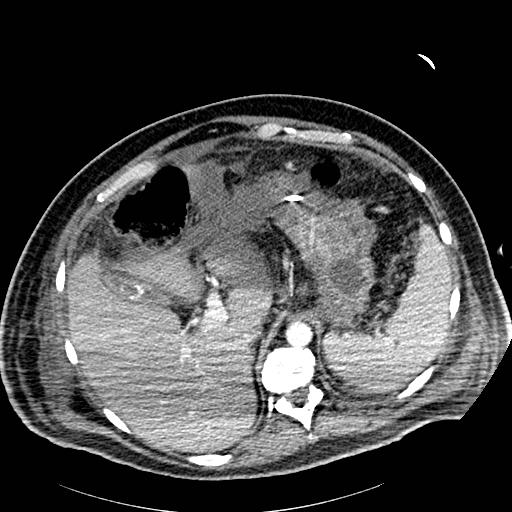 Acute pancreatic necrosis (Radiopaedia 13560-18502 Axial C+ portal venous phase 8).jpg