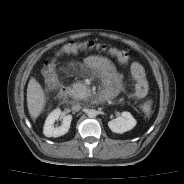 Acute pancreatitis (Radiopaedia 26663-26813 Axial C+ portal venous phase 35).jpg
