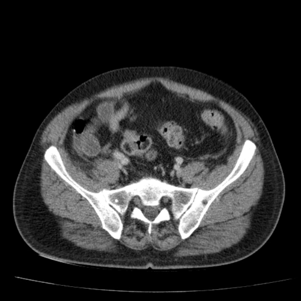 Acute pancreatitis (Radiopaedia 26663-26813 Axial C+ portal venous phase 66).jpg