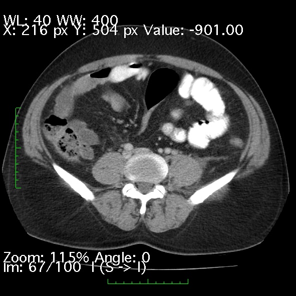 File:Acute pancreatitis (Radiopaedia 34043-35276 Axial C+ portal venous phase 67).jpg