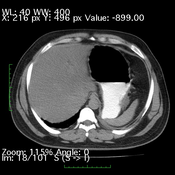 Acute pancreatitis (Radiopaedia 34043-35276 Axial non-contrast 18).jpg
