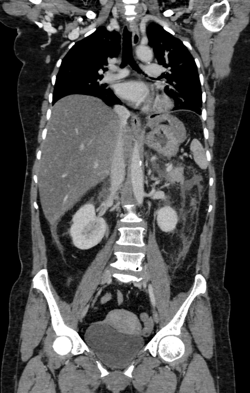 Acute pancreatitis (Radiopaedia 80007-93285 Coronal C+ portal venous phase 70).jpg