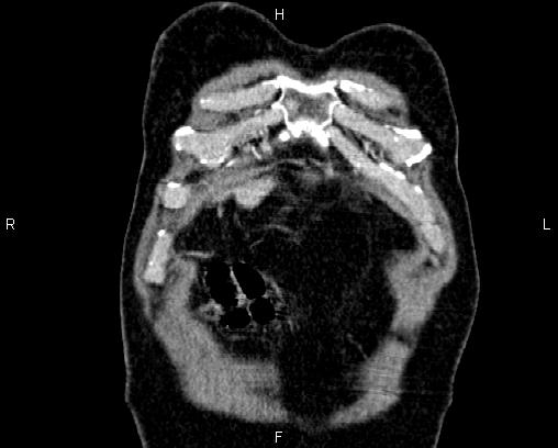 Acute pancreatitis (Radiopaedia 85146-100701 Coronal C+ portal venous phase 2).jpg