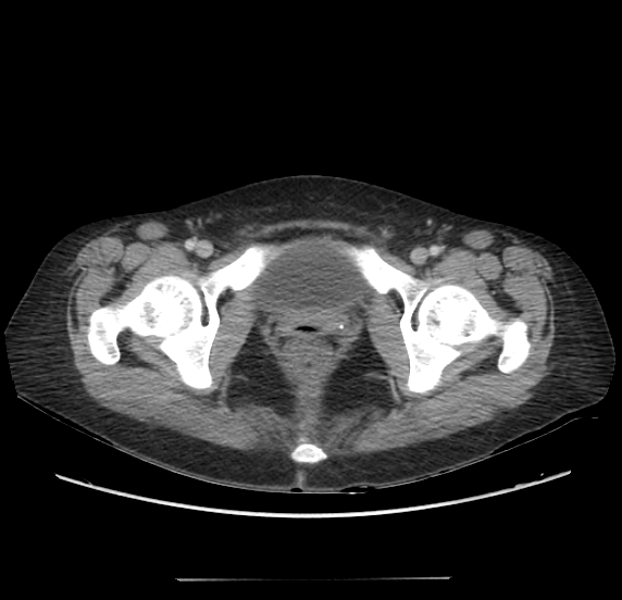 Acute pancreatitis - Balthazar E - post ERCP (Radiopaedia 27562-27772 Axial C+ portal venous phase 75).png