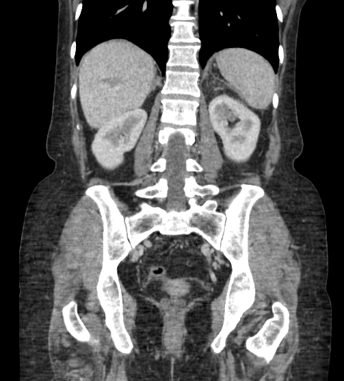 File:Acute pancreatitis - Balthazar E - post ERCP (Radiopaedia 27562-27772 Coronal C+ portal venous phase 62).png