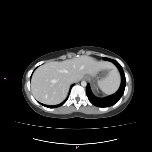 Acute pancreatitis secondary to stone at minor papilla and pancreatic divisum (Radiopaedia 76570-88333 Axial C+ portal venous phase 13).jpg