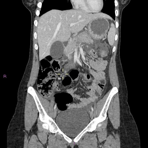 File:Acute pancreatitis secondary to stone at minor papilla and pancreatic divisum (Radiopaedia 76570-88333 Coronal C+ portal venous phase 14).jpg